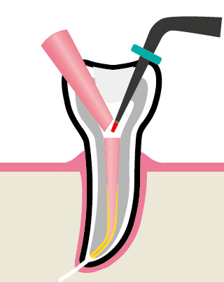 Вертикальная конденсация - обрезка мастер-штифта